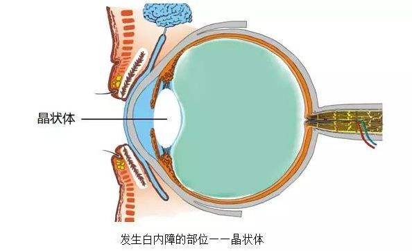 西宁爱尔：白内障通过药治，只能减缓视力下降程度，难以再提高视力(图1)