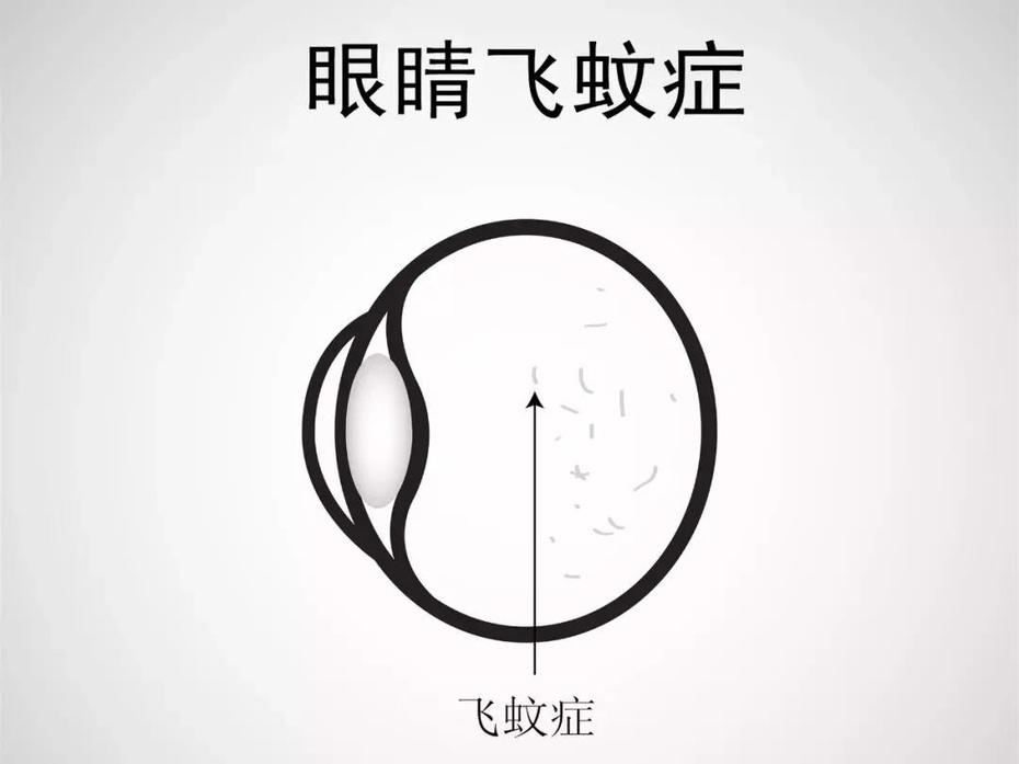 西宁爱尔：病理性飞蚊症的特点有哪些(图1)