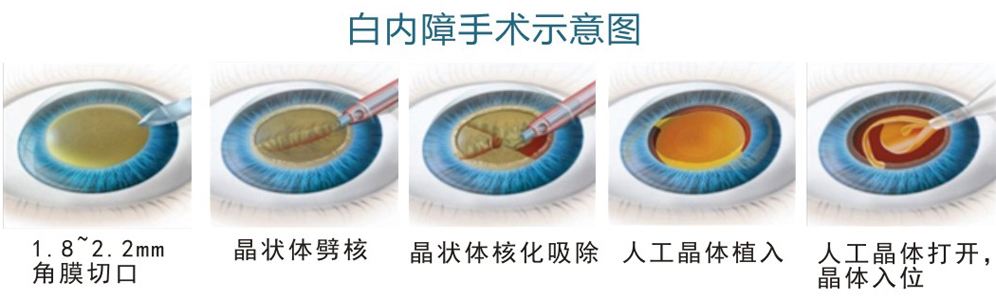西宁爱尔：白内障手术关键的问题和答案汇总(图1)