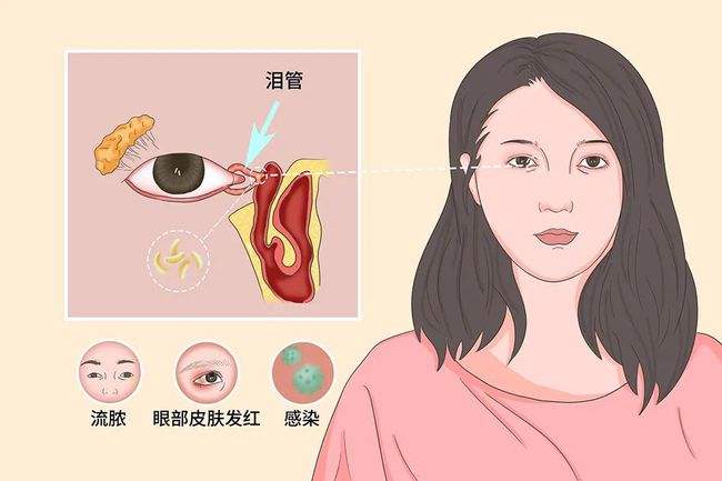 西宁爱尔眼科医院：“迎风流泪” 警惕泪道阻塞(图1)