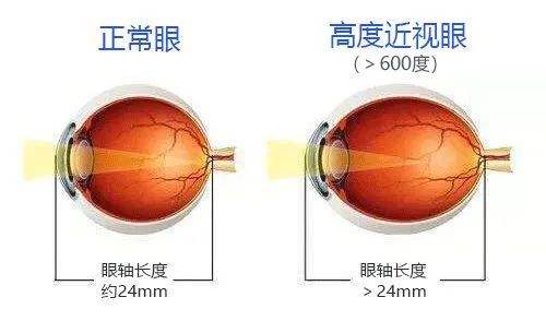 西宁爱尔：近视之后做近视手术怎么样啊(图1)