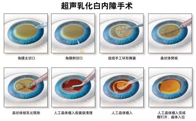 西宁爱尔：白内障除了手术还有其他诊治方式吗(图1)