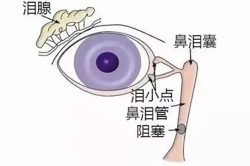 西宁爱尔眼科医院： 干眼困扰之泪道阻塞性疾病(图1)