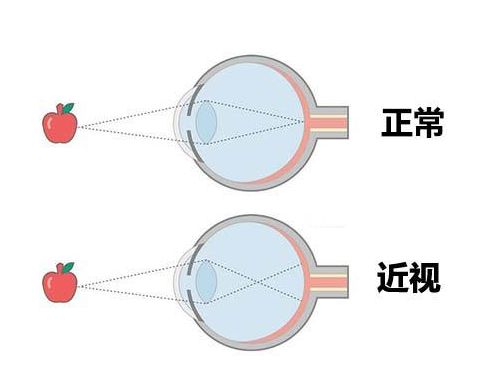 西宁爱尔：角膜屈光近视手术前需要做好哪些准备(图1)