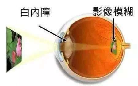西宁爱尔眼科医院：白内障手术方案如何选择(图1)