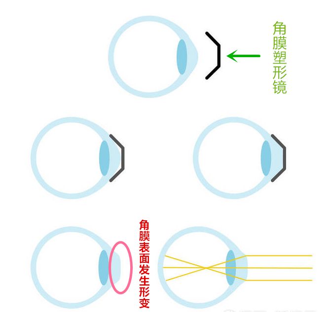 青海眼科：角膜塑形镜镜片何需更换(图1)