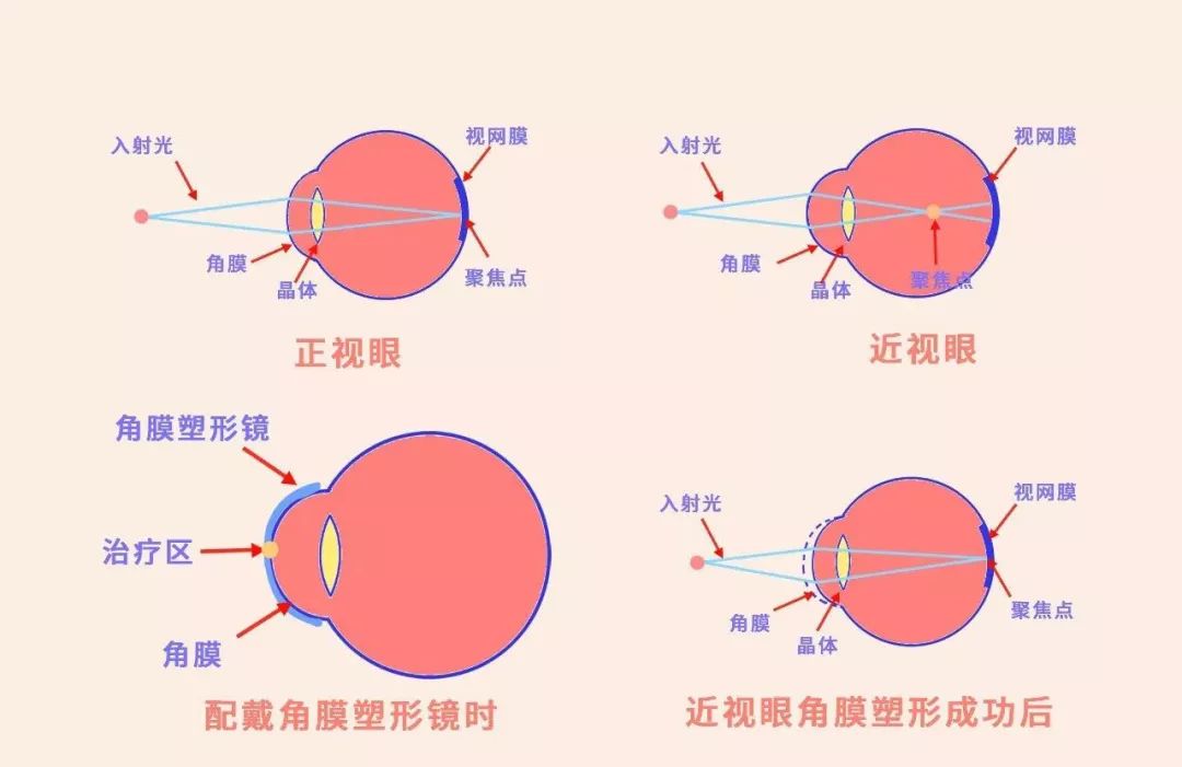 西宁爱尔：常见的角膜塑形镜误区(图1)