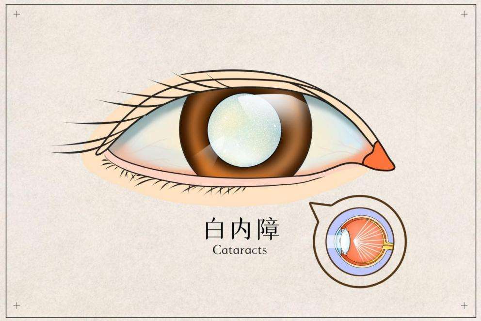 西宁爱尔眼科医院：白内障并非老年人专属，各种年龄段都要小心(图1)