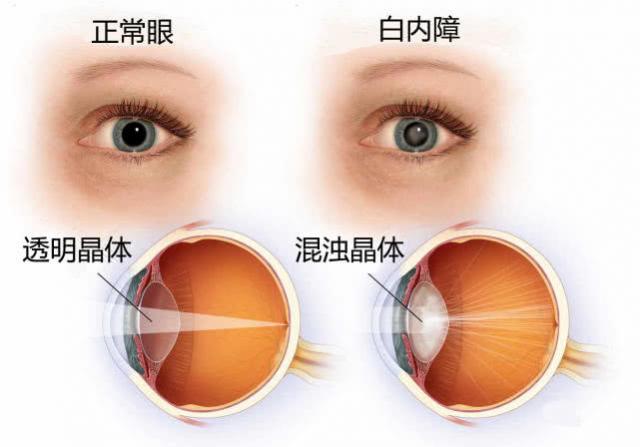西宁爱尔眼科医院：要在白内障的早期去医院做正规诊治(图1)