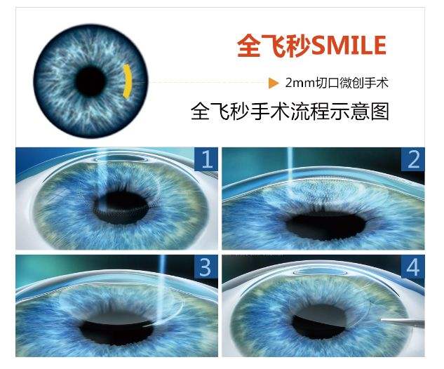 西宁爱尔：近视可以选择不戴镜，做全飞秒近视手术(图1)