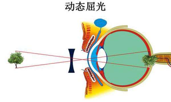 青海眼科：高度近视要如何“逆袭”(图1)