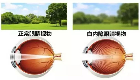 西宁爱尔眼科医院：白内障超声乳化术标准化流程(图1)