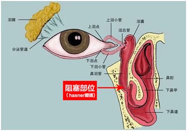 西宁爱尔眼科医院：“流泪”---原来是泪道阻塞(图1)
