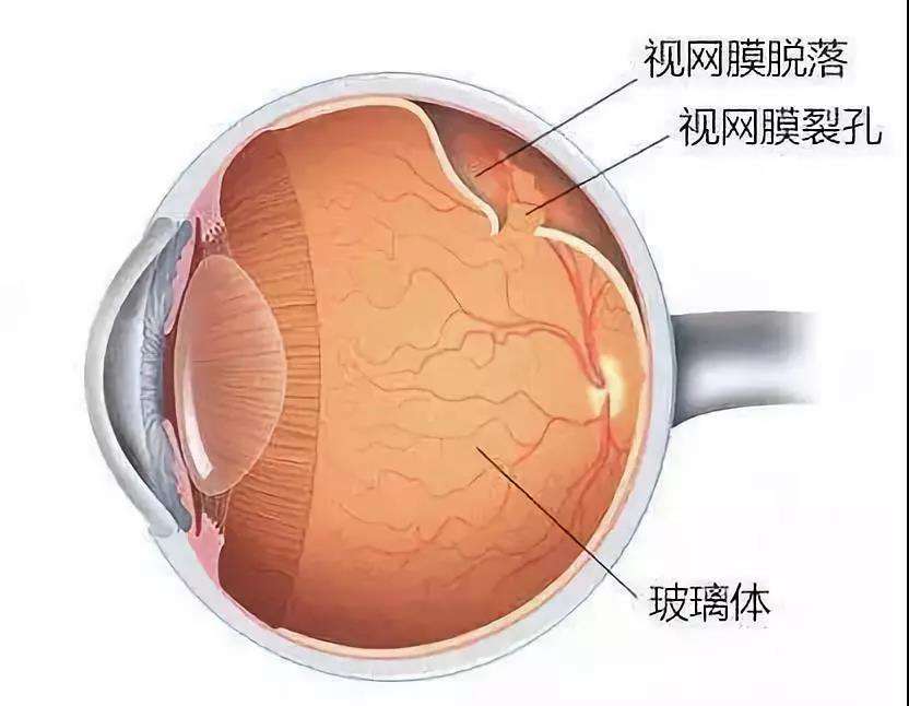 西宁爱尔眼科医院：视网膜脱离悄悄发生，你能快速发现它吗(图1)