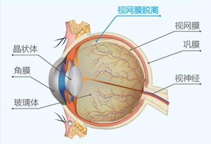 西宁爱尔眼科医院：视网膜脱离悄悄发生，你能快速发现它吗(图1)